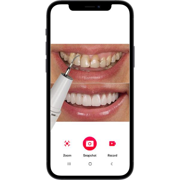 Effektiver Ultraschall-Zahnsteinentferner mit HD-Kamera (weiss): Akku-betriebener Plaque-Entferner für strahlend saubere Zähne